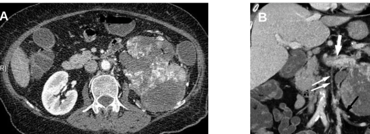 Figure 6 – Relationship to the colon seen better on coronal reformat. A) Axial section through the left renal mass showing fat stranding (white arrow) suggesting extension of the mass into the colon