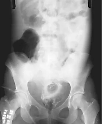 Figure 2 – Sonography showing discontinuity of peritoneal blad- blad-der wall.