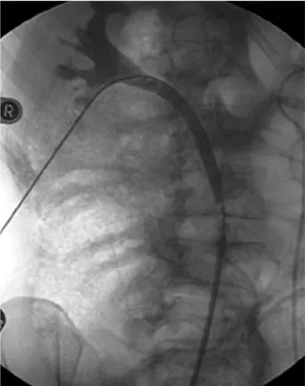 Figure 2 – Original (left) and bent (right) puncture needle both with stylet.
