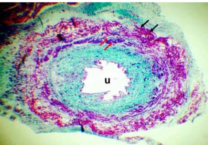 Figure 6 – Fetus with 30 WPC. Section at the level of the veromontanum, where in this older fetus we can now observe the extension of the striated muscle (black arrows) and the smooth one (white arrows) for the lateral region of the prostate