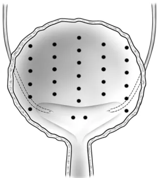 Figure 2 – University of Chicago botulinum toxin injection protocol (Reprinted with permission from Elsevier Inc, Urology, Rapp DE et al., ref