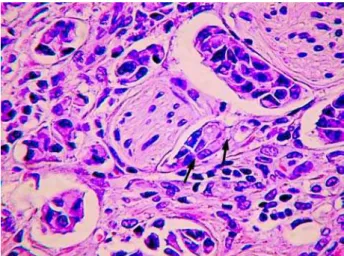 Figure 1 – Perineural invasion by the transitional cell carcinoma of the bladder (arrows).