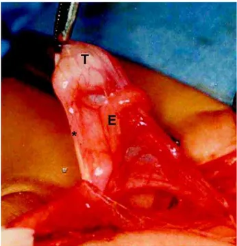 Figure 1 – This figure shows a patient with cryptorchidism during surgery. The testis was in the inguinal canal and we can observe the gubernaculum testis (*) attached to the inferior pole of the testis (T) and the epididymis (E), which presented a disjunc
