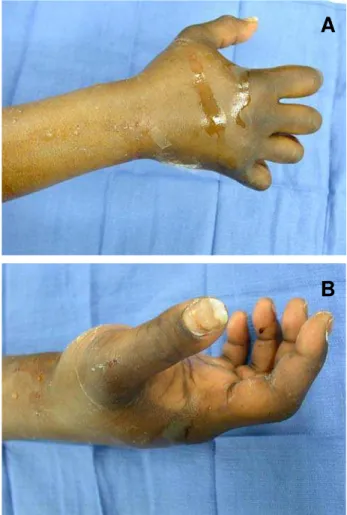 Figure 2A and B – Elevated forearm compartment pressures lead to this typical flexed appearance.