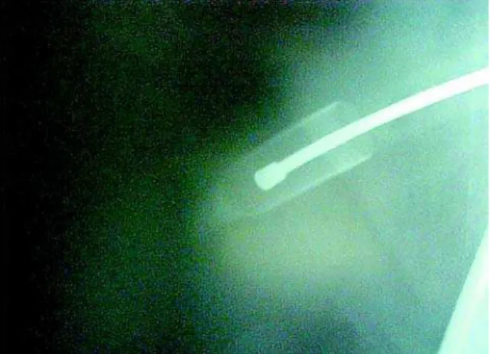 Figure 1 – Rx showing a single prosthesis implanted in an inverted fashion.