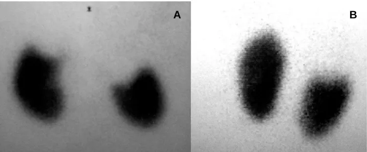 Figure 2 – Selected IMAGES of the  99m Tc-DMSA showing bilateral upper-pole exclusion on the preoperative (A) and parenchymal accommodation on the postoperative period (B).