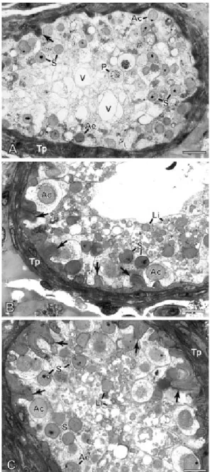 Figura 7. Fotomicrografias do testículo de homens idosos com câncer de próstata que sofreram  tratamento hormonal exclusivo antes da orquiectomia bilateral (grupo TH+CC)
