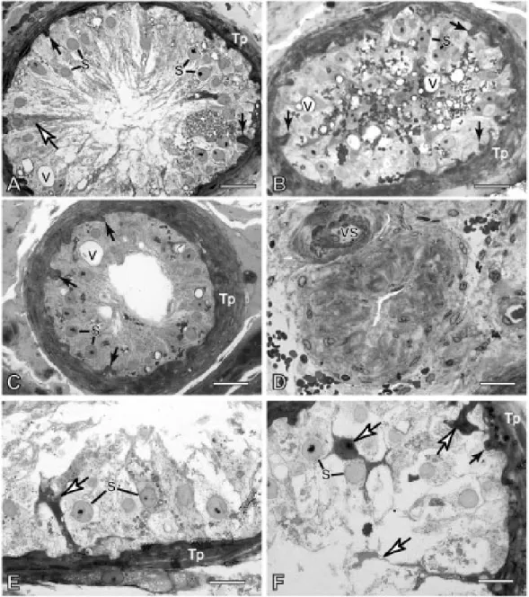 Figura 8. Fotomicrografias de túbulos seminíferos de testículos de homens idosos com câncer de próstata  que sofreram tratamento radioterápico antes da orquiectomia bilateral (grupo TR+CC)
