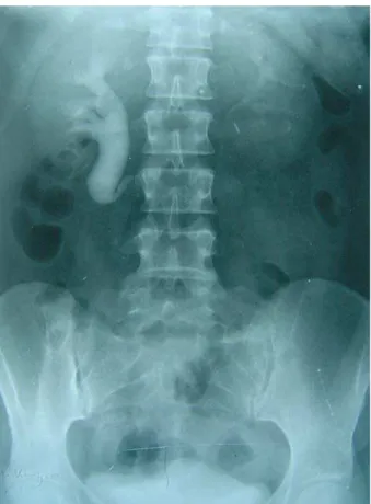 Figure 3 – Mobilization of renal pelvis and ureter.