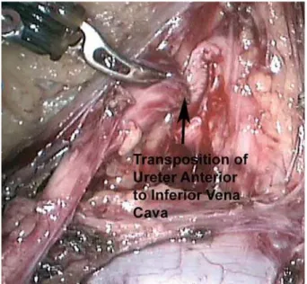Figure 7 – Antegrade JJ stent insertion.