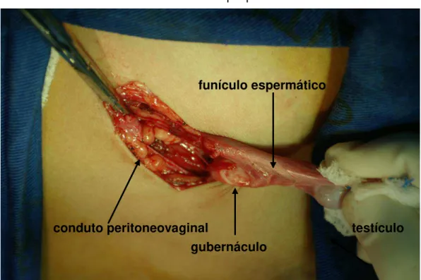 FIGURA 1 - Orquiopexia 