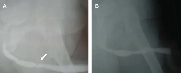 Figure 2 – A)- Preoperative urethrography showing urethral stricture (arrowhead). B)- Postoperative urethrography showing widely  patent urethra after bipolar vaporization.