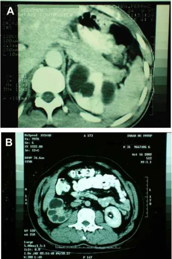 Figure 3 – Computed tomography showing calyceal dilatation  in the left kidney.