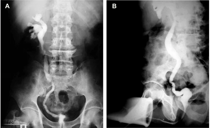 Figure 5 – A) Intravenous urography with left non-function kidney, B) Voiding cystography shows contracted bladder and right vesi- vesi-FRXUHWHUDOUHÀX[