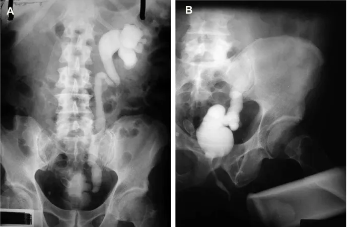 Figure 6 – A) Intravenous urography with right non-function kidney, B) Voiding cystography shows contracted bladder and left vesi- vesi-FRXUHWHUDOUHÀX[