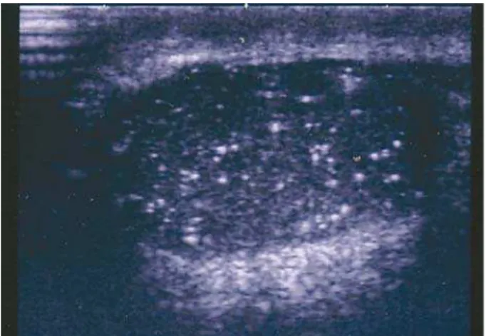 Figure 1 – Longitudinal sonogram of the testicle shows  QXPHURXVVPDOOHFKRJHQLFIRFLRIFDOFL¿FDWLRQZLWKRXW posterior shadowing.