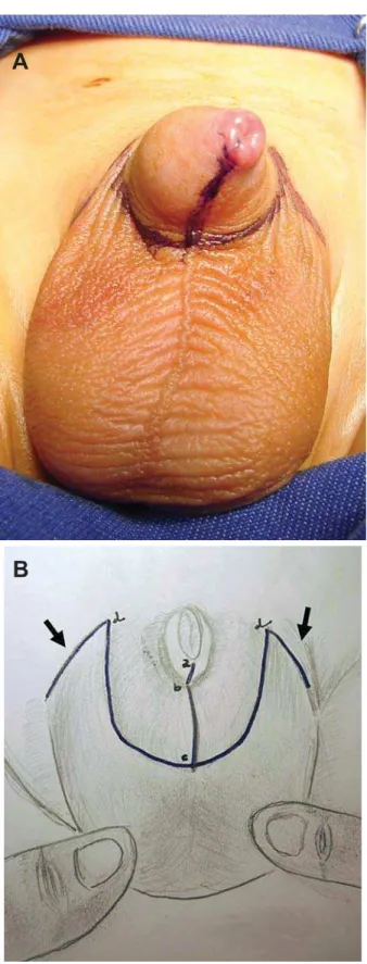 Figure 5 – Traction in the ventral preputial ring changing the  broken incision into a strait line.