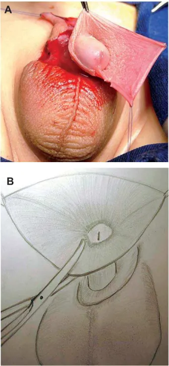 Figure 6 – A) Cutting the inner prepuce. B) Schematic draw- draw-ing.