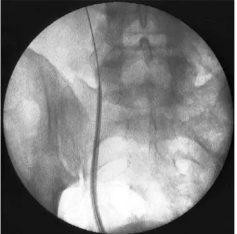 Figure 1 – Access sheath placed over a guide wire in the right  ureter.
