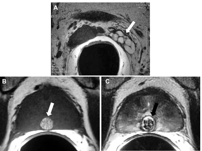 Figure 1 – Hemorrhagic seminal vesicle associated with a complicated midline prostatic cyst (utricular cyst)
