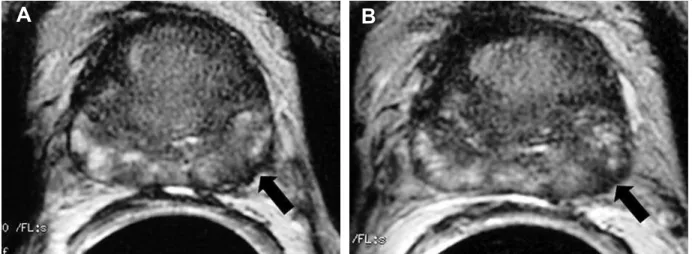 Figure 4 – Prostate cancer.  A) and B) E-MRI, axial plane, T2-weighted images showing focal area of  low signal intensity in the lat- lat-eral aspect of the left periphlat-eral zone (arrow) associated with irregular thickening of the capsule of the  prosta
