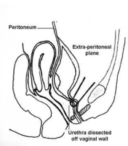 Figure 1 – Relevant anatomy showing initial plane of dissec- dissec-tion.