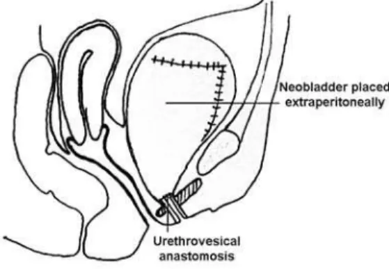 Figure 4 – Neobladder in extraperitoneal pelvic space.