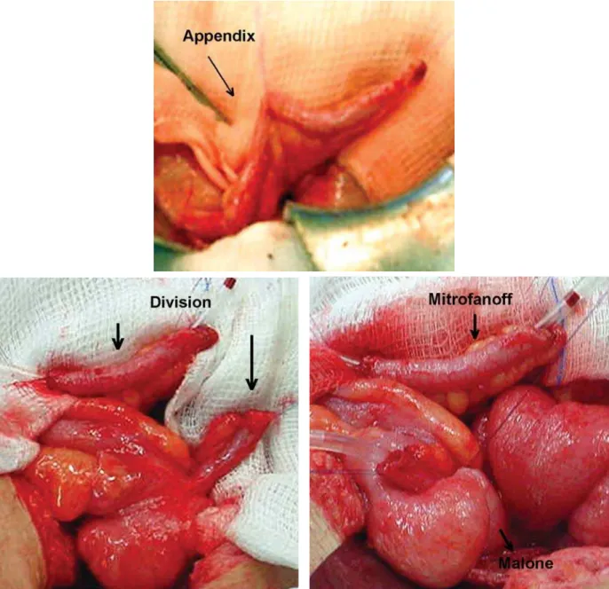 Figure 1 – The appendix was divided into two parts in order that its proximal part was utilized for intestinal catheterization and its  distal part as a Mitrofanoff conduit for performing intermittent urinary catheterization.