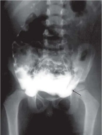 Figure 1 – Peritoneography. After intraperitoneal injection of contrast medium, anteroposterior pelvis X-ray shows no evidence of fissures or irregularities in the peritoneum medial or lateral to the epigastric notch (arrow), and no evidence of the presenc