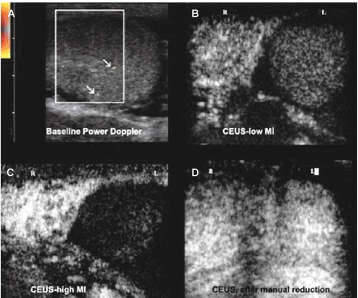 Figure l  –  Acute testicular torsion. A 27 year old male with acute left hemiscrotum