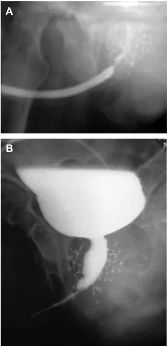 Figure 1 – Retrograde urethrography (A) and voiding cysto-ure- cysto-ure-thrography (B) showing a stricture at the distal prostatic urethra  after brachytherapy