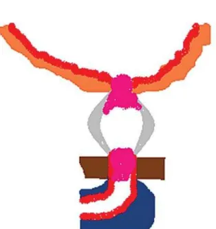 Figure 2 – Proposed pathogenesis for strictures at the bladder neck and membranous urethra
