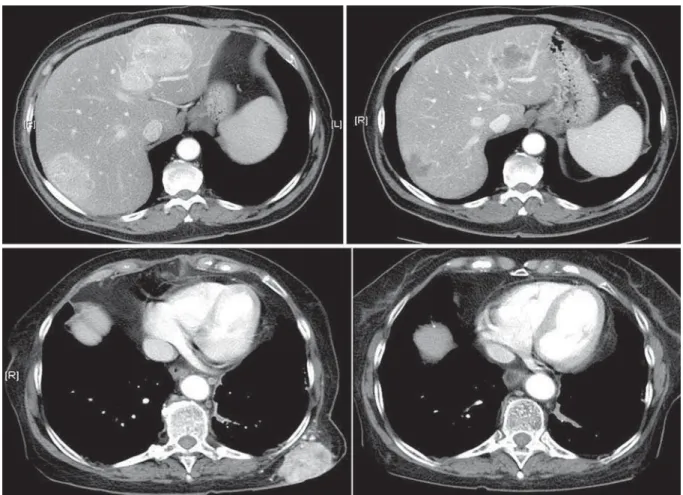 Figure 2 – Axial CT image showing examples of partial response of a renal cell carcinoma metastases in liver and lung.