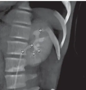 Figure 1 – Three-dimensional volume rendered oblique coronal  reformatted image with 10% gray demonstrating the accessibility  of stone bearing locations when the intercostal approach is used  for percutaneous removal of calculi from the posterior superior