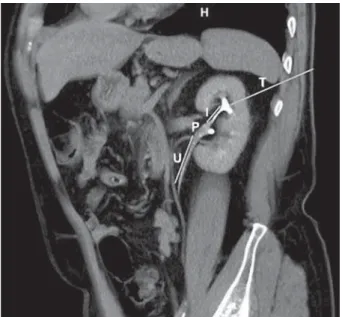 Figure 2 – Three-dimensional oblique coronal multi-planar  reformatted image demonstrating a relatively straight path from  the point of entry, through the infundibulum and renal pelvis and  to the ureter, afforded by an intercostal posterior upper polar  