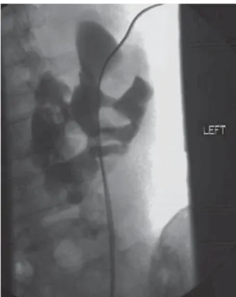 Figure 4 – The superior posterior calyx of a horseshoe kidney  is easily accessed via an intercostal approach