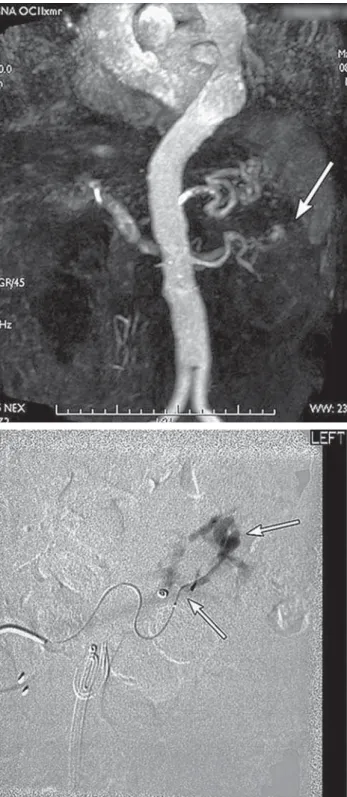 Figure 6 –  A) Coronal maximum intensity projection of an  abdominal MR angiogram demonstrating a post lithotripsy A-V  fistula of the left kidney (white arrow)