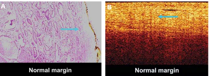 Figure 4 – A) Hematoxylin-eosin staining of positive surgical margin of prostate gland (arrow)