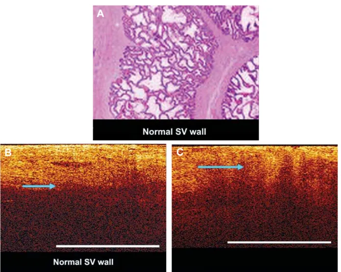 Figure 6 – A) Hematoxylin-eosin staining of normal seminal vesicle. B) Corresponding optical coherence tomography  (OCT) of normal seminal vesicle (arrow)