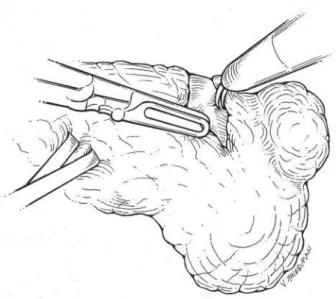 Figure 4 – Renal mass identification and determination of mar- mar-gins of resection.