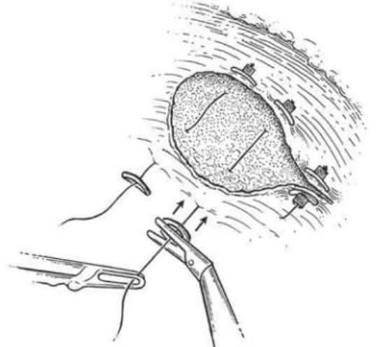 Figure 6 – Sliding-clip renorrhaphy.