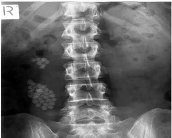 Figure 1 –  Patient with situs inversus and left to right crossed- crossed-fussed ectopic kidney with ureteropelvic junction obstruction and  multiple stones in the ectopic kidney (lower moiety)