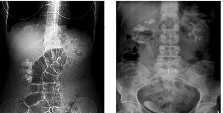 Figure 3 – Retrograde pyelography of a patient with an ectopic  pelvic kidney, ureteropelvic junction obstruction and a 2 cm stone  in the upper pole (arrow)