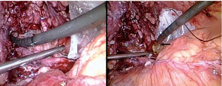 Figure 4 – Left: Flexible nephroscopy through the laparoscopic pyelothomy. Right: Basket extraction of encountered stones (arrow)