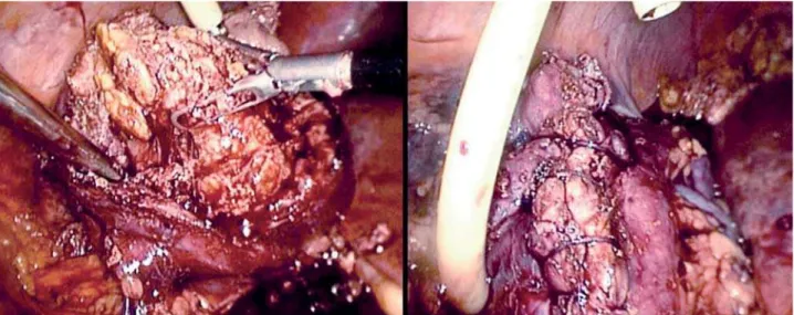 Figure 6 – Left: Laparoscopic anatrophic nephrolithotomy, stone extraction. Right: One layer LapraTy™ assisted suturing of the  kidney.