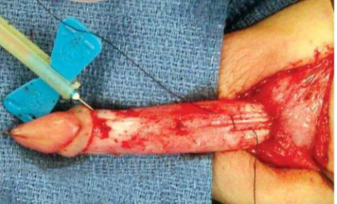 Figure 1 –  Shows the diagonal corporal plication suture, which  is more distal on the right corpora and more proximal on the left  corpora to correct the most common direction of penile torsion