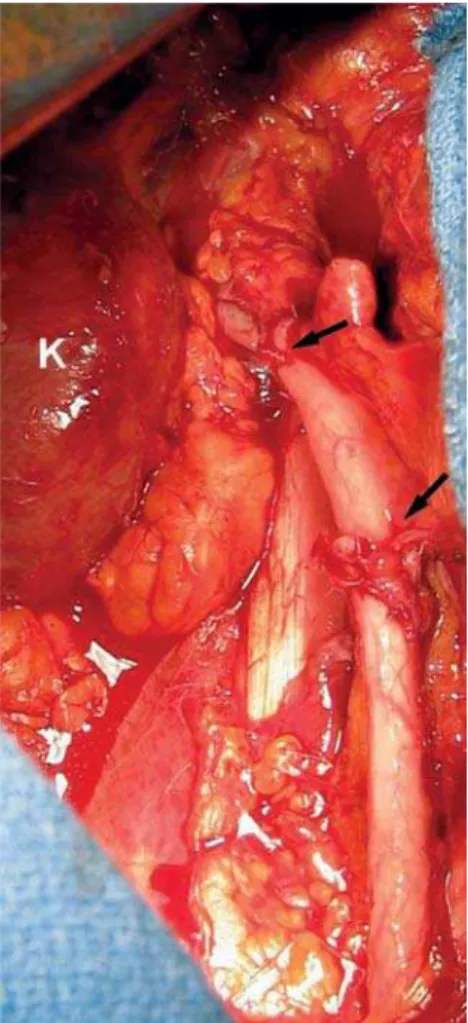 Figure 2 – Completed appendiceal interposition (arrows). K =  right kidney.