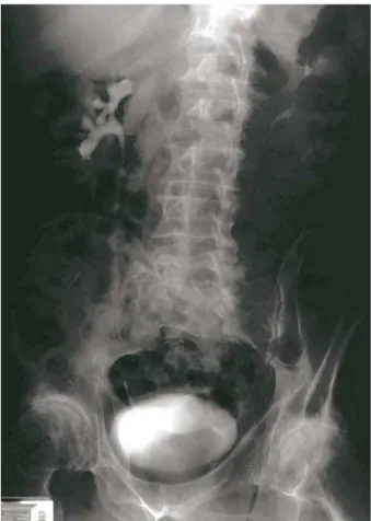 Figure 3 – Intravenous pyelogram at eight months postopera- postopera-tively showing a patent graft with no evidence of stricture or  hydronephrosis.