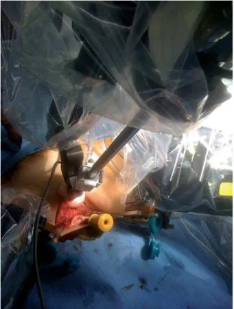 Figure 1 – Rhomboid trocar positioning for LESS robotic as- as-sisted. Dissection of aponeurosis allowed a separation of 3.5 cm  between ports.