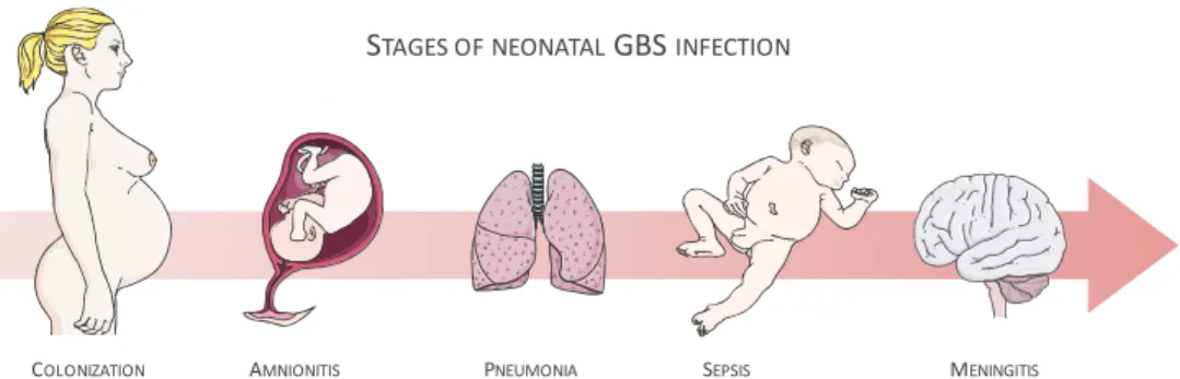 Figure 1 | Schematic view of the stages of neonatal GBS infection 